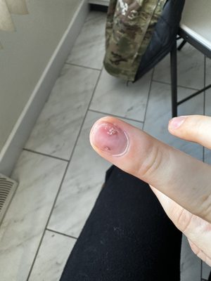 Two weeks after nail damage