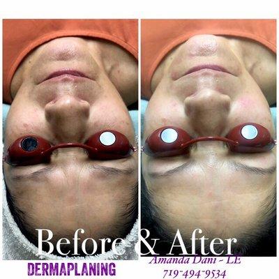 Dermaplaning Facial