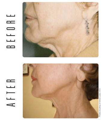 Skin Tightening Results!