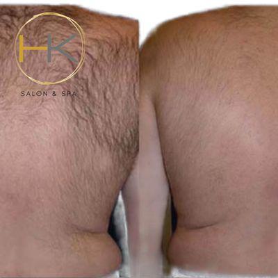 Laser Hair Removal