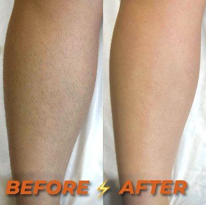 Half legs sugaring- stunning result that will let you feel confident in any situation‍