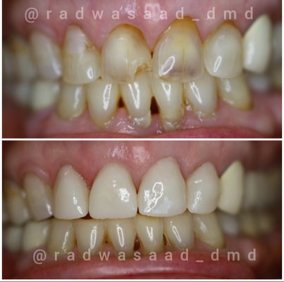 Cosmetic porcelain veneers to fix the broken and misaligned teeth , completed on the same day by Cosmetic Dentist Dr. Radwa Saad