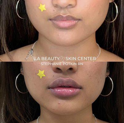 Non-surgical lip augmentation by Stephanie Potkin, RN