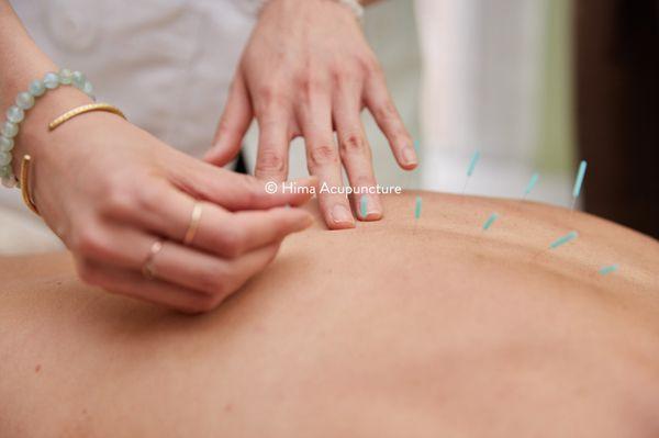 Snow Xia, L.Ac. | midtown, NoMad acupuncturist | giving an acupuncture treatment for back pain relief