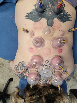 Me getting "cupping"