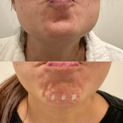 Help smooth chin dimpling with Botox!