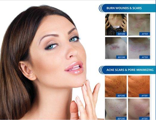 Dermapen:  Microneedling