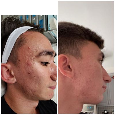 One treatment of VI peel