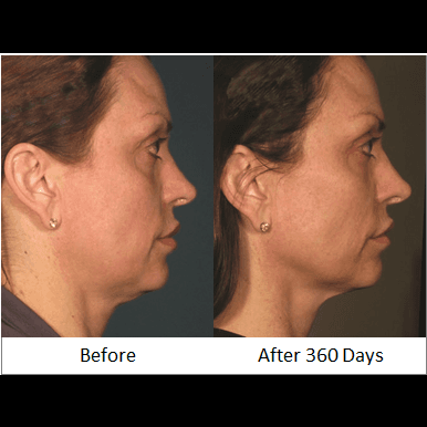 Before & after photos from Ultherapy's, non-invasive, neck and chin lift.  You will be amazed by the results  that take 3 months