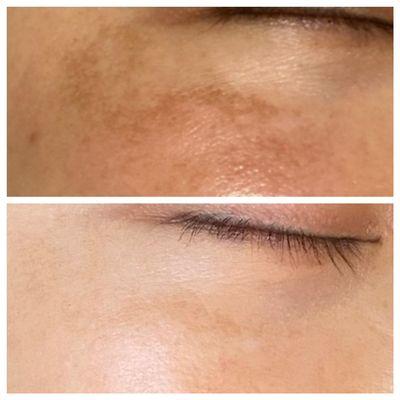 Melasma sunspot removal done with Fraxel and ND YAG Laser(20 sessions)