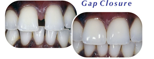 Gap Closure