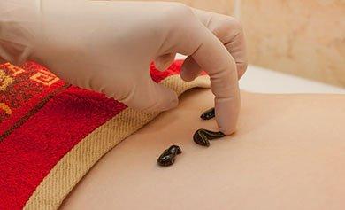 Medicinal Leech Therapy