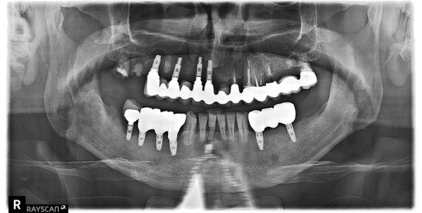 Voila.  Look on the left. 4 implants.    On the right. My teeth's as post.