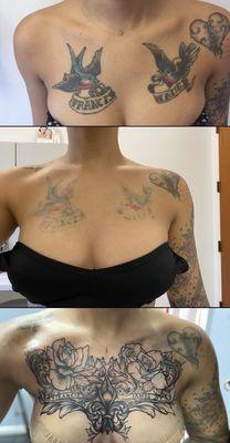 -Top Photo is Pre Laser -Middle Photo is Post 5 Laser Treatments - Bottom photo is 1st session of cover up !