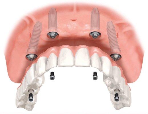 Progressive Periodontics and Implant Dentistry