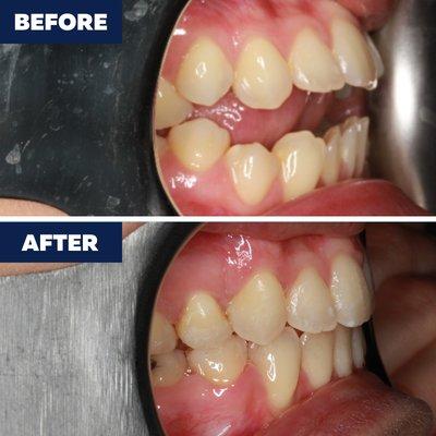 Open bite treated braces 24 months. Call us to schedule a consultation!