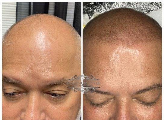 Scalp Micropigmentation (SMP)