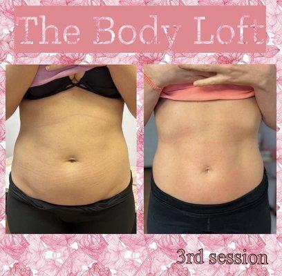 This photo was taken after client's third session with laser lipo and body cavitation.