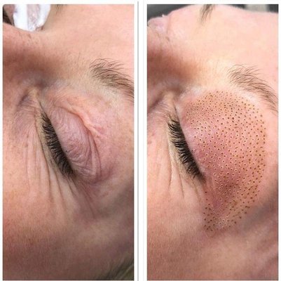 fibroblast skin tightening