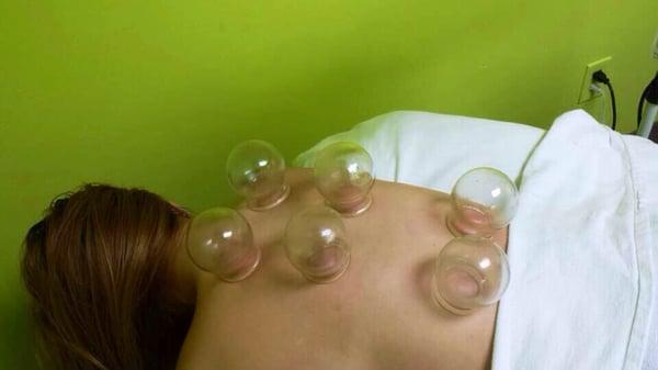 Cupping