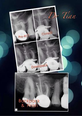 Root Canal Treatment through the existing crown