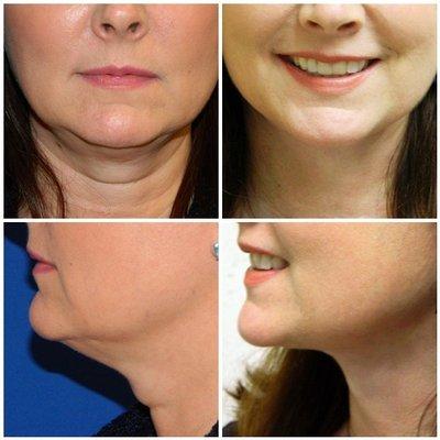 Neck Liposuction