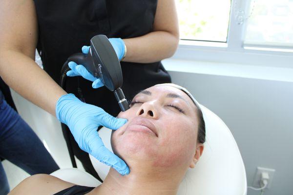 Our Doctor, Linette, Rivera, performing an Opus Plasma Procedure for Skin Resurfacing.