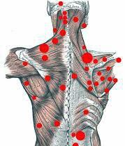 Common 'trigger points' on back and neck that cause pain and muscle tightness