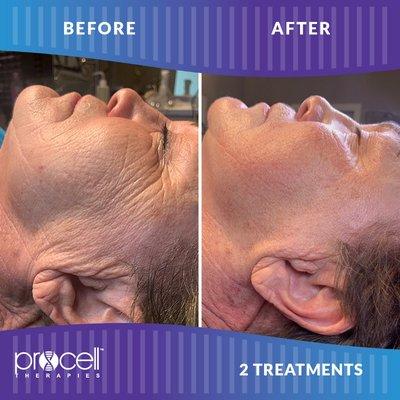 Procell Microchanneling facial treatment