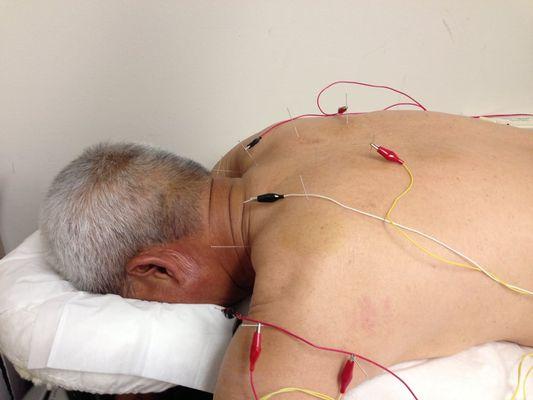 Dr. Yu uses Electro-Acupuncture to treat a patient with neck shoulder and back pain, common problems for people work at front of computer.