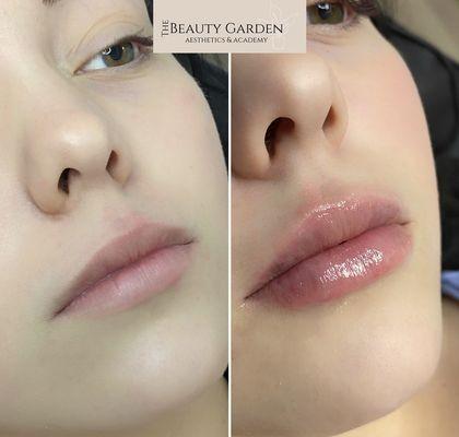 1mL needle free lip filler