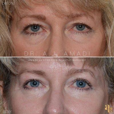 Lower Blepharoplasty before & after