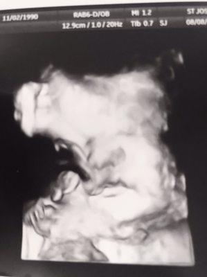 3D ultrasound