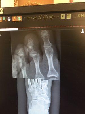 Before X-ray you see the third toe bone is intact but the joint is dislocated