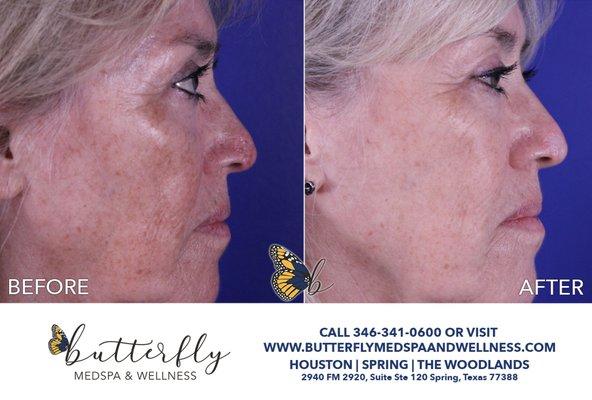 Before and after with Hydrafacial