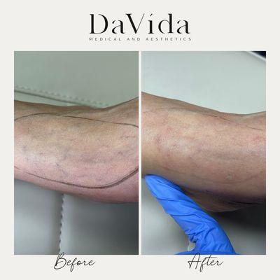 Before and after of spider vein removal done at premium medical spa in San Antonio - Davida Medical and Aesthetics