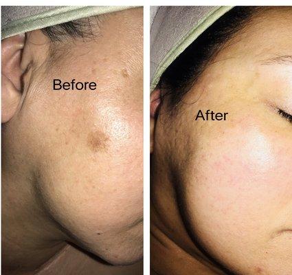 Vitamin c serum for pigmentation correction