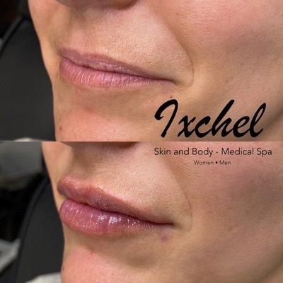 Lip Augmentation with Restylane Kysse