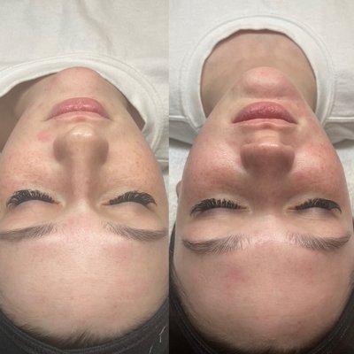 Hydrafacial