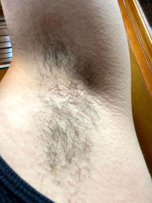 Before laser hair removal of the underarm.