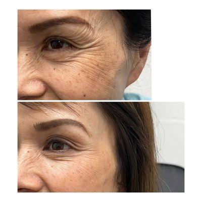 Botox for crow's feet, natural look