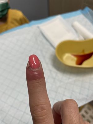 Paronychia, nail infection.