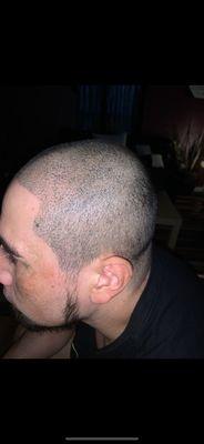 Side and scalp hair micro pigmentation.