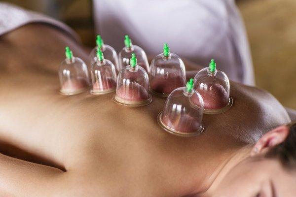 Therapeutic Cupping