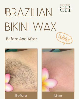 Brazilian wax before and after