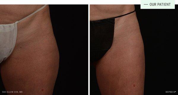 CoolSculpting for the outer thighs