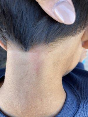 The burns on the back of his neck literally after walking out the salon.