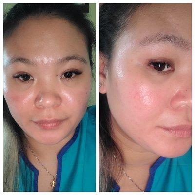 After Acne Facial Treatment