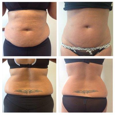 Lipo cavitation