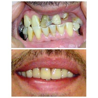 DR. IRINAS PATIENT. Before stained & chipped teeth. After, restored with fixed bridge.